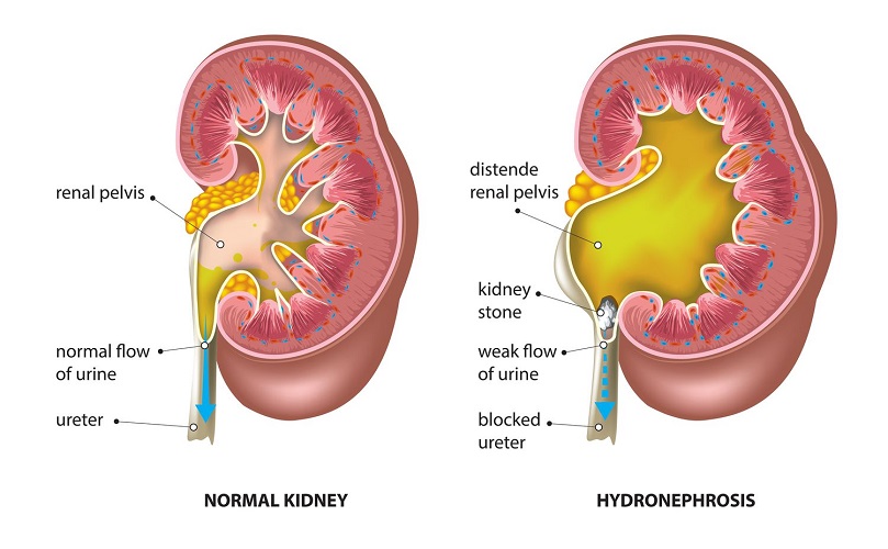 hydronephrosis